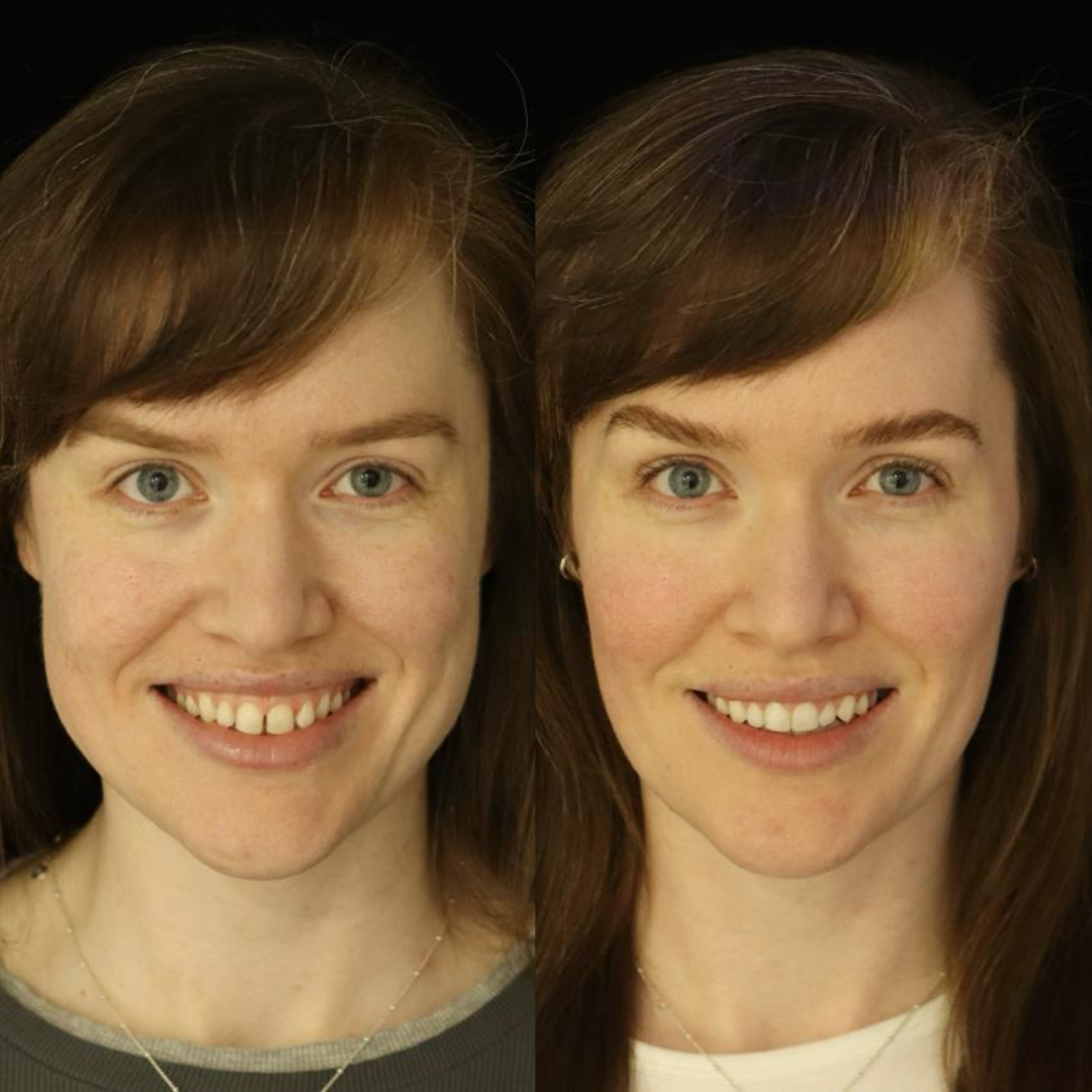 Invisalign before and after result for Sarah R