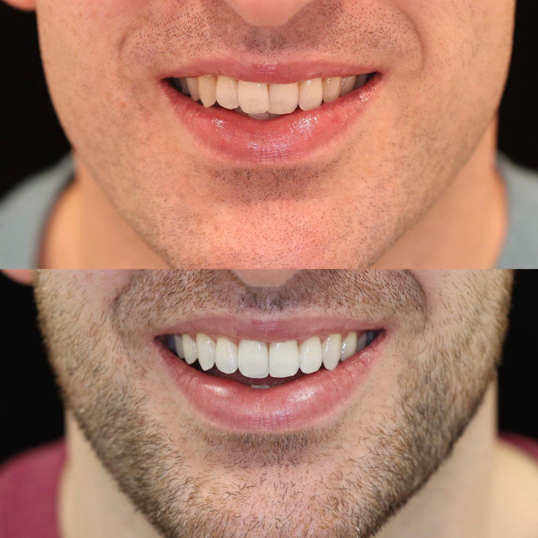 Invisalign before and after result for Peter E