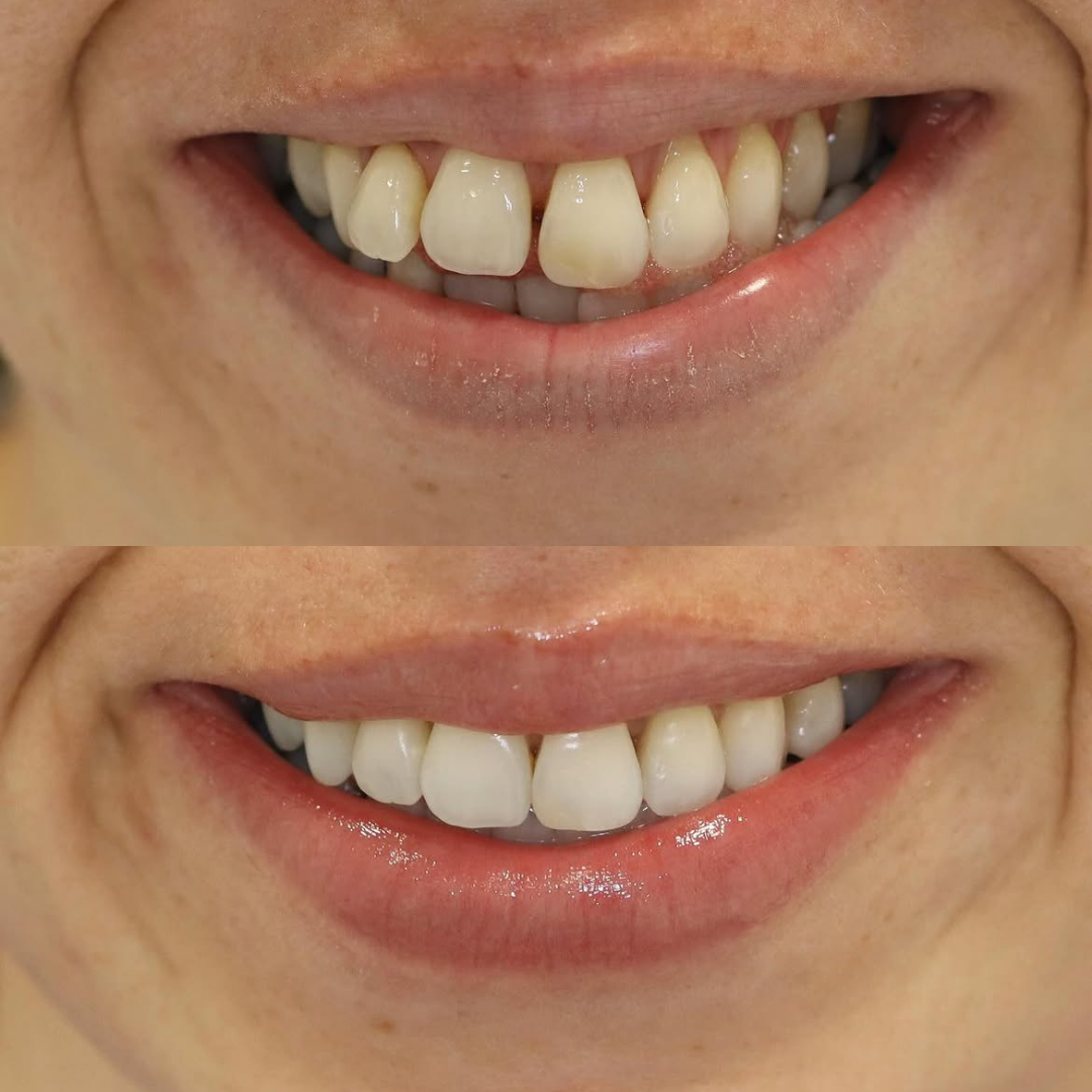 Invisalign before and after result for Annie W