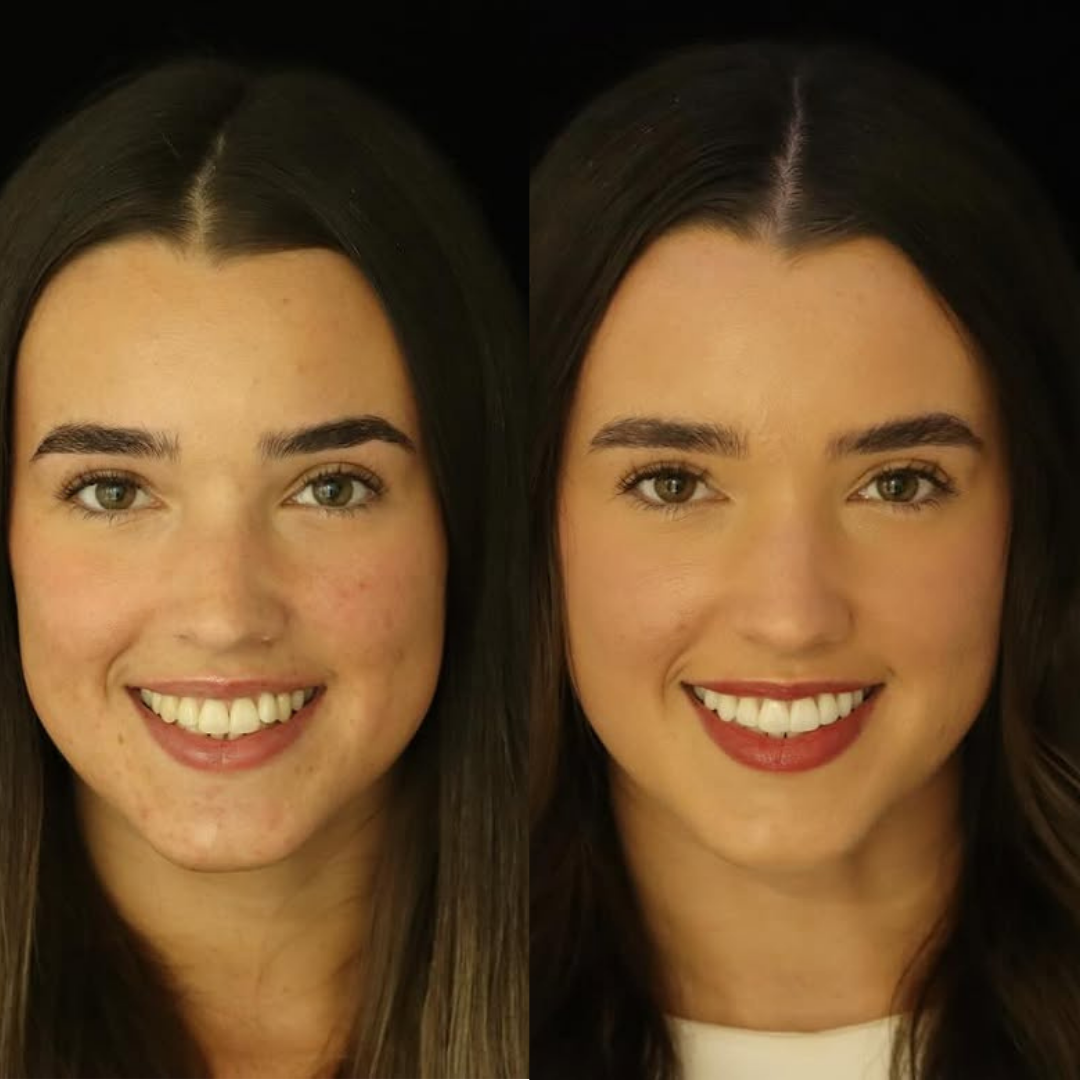 Invisalign before and after result for Verified patient
