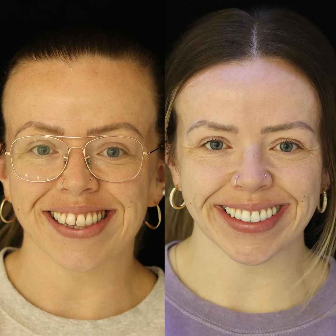 Invisalign before and after result for Annie Walker