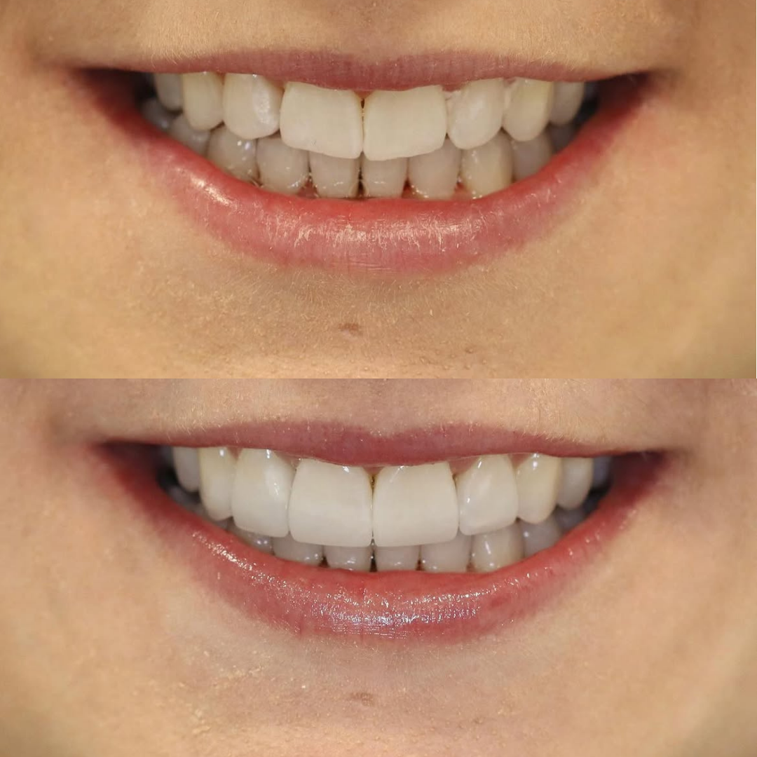 Invisalign before and after result for Verified patient
