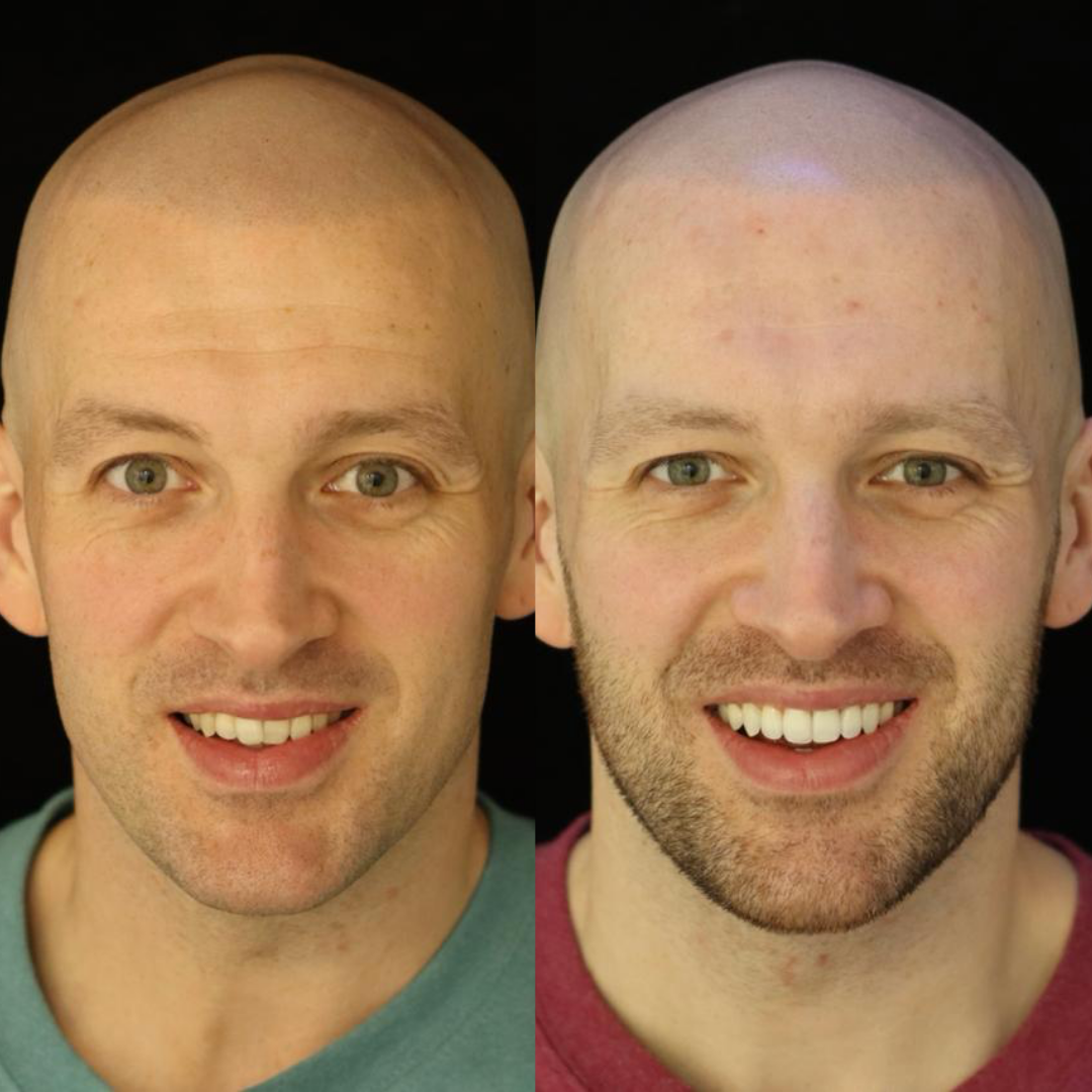 Invisalign before and after result for Peter E