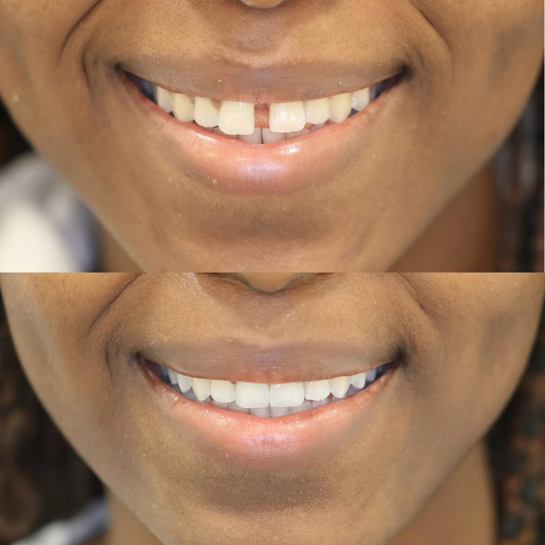 Invisalign before and after result for Verified patient