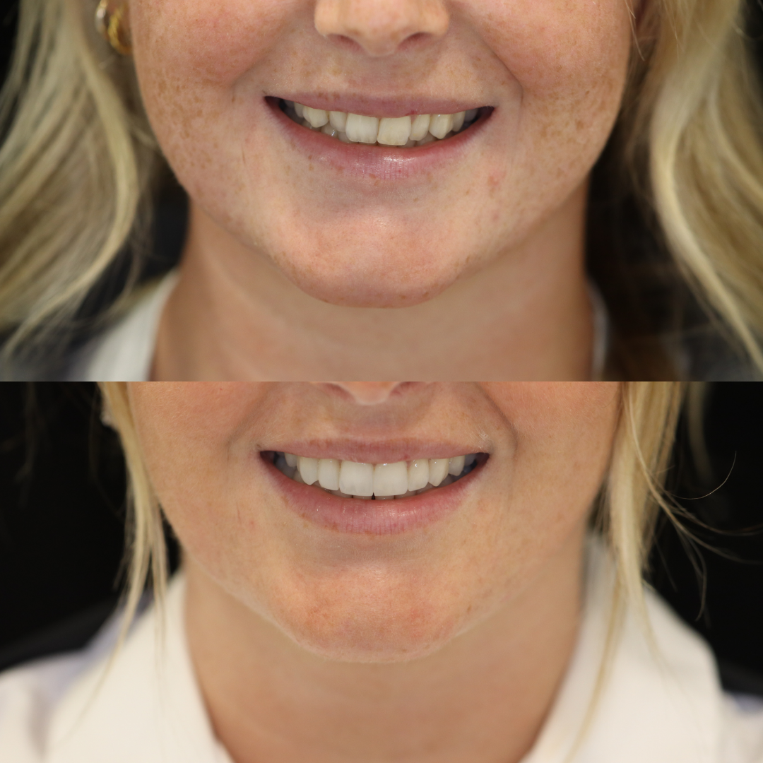 Invisalign before and after result for Tamzin M