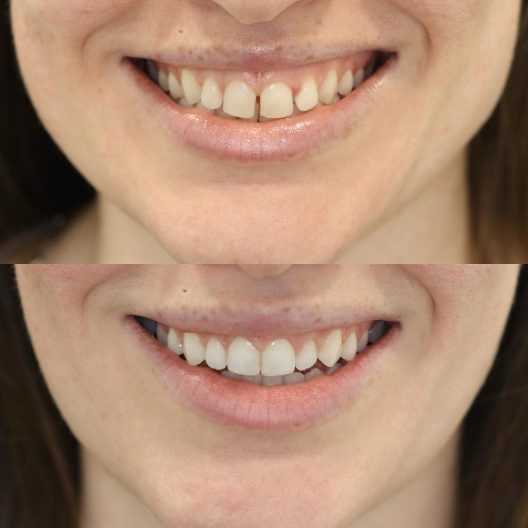 Invisalign before and after result for Sarah R