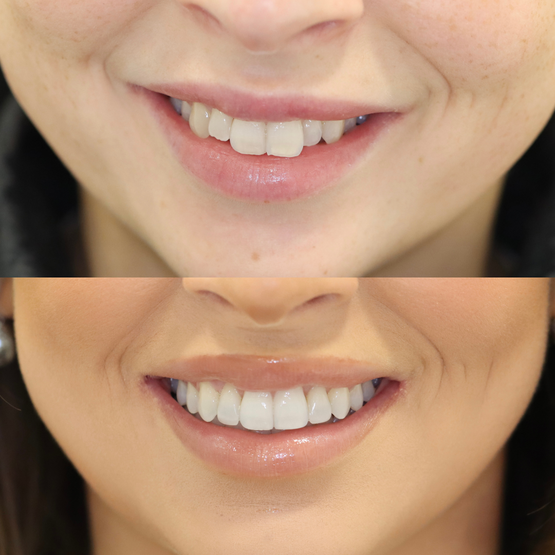 Invisalign before and after result for Melissa S